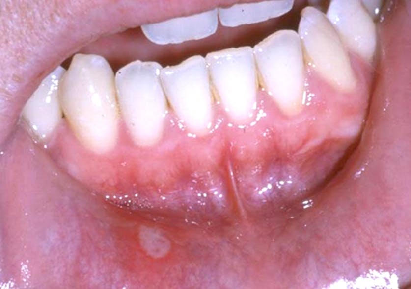 Figure 5: Aphthous ulcer