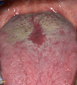 Figure 6: Median rhomboid glossitis Figure 6: Median rhomboid glossitis