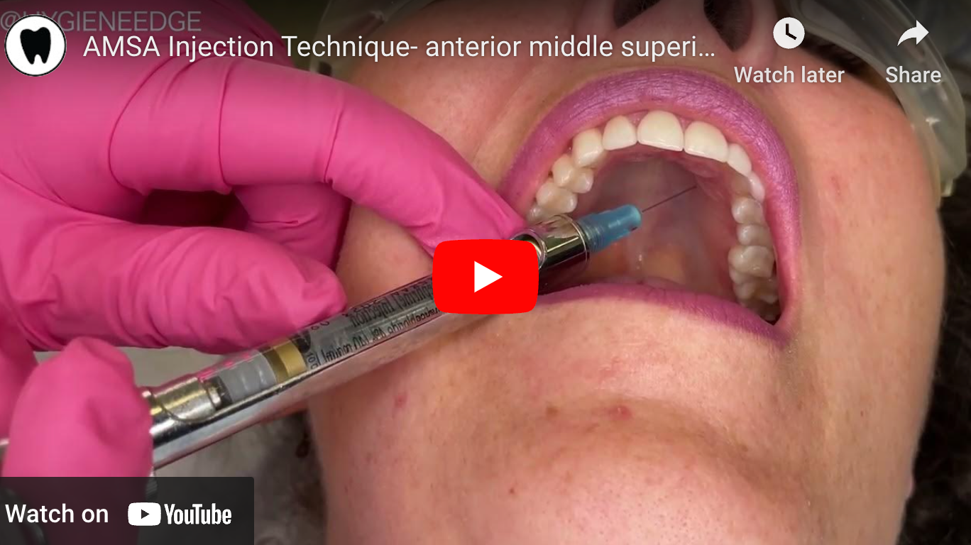 Anterior Middle Superior Alveolar Amsa Nerve Block