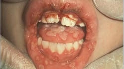 primary herpes simplex virus (HSV)