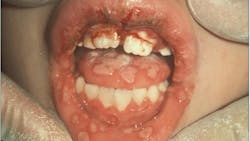 primary herpes simplex virus (HSV) primary herpes simplex virus (HSV)