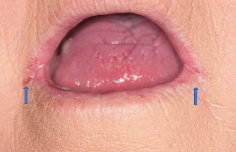 Figure 3: Angular cheilitis in female with xerostomia