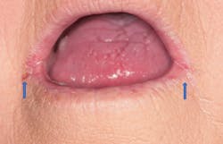 Figure 3: Angular cheilitis in female with xerostomia Figure 3: Angular cheilitis in female with xerostomia