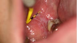 Lichen Planus Lichen Planus