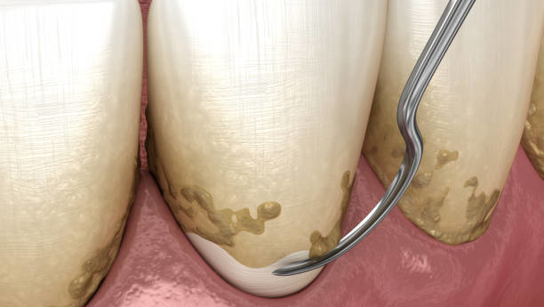 Chronic Inflammatory Periodontal Disease