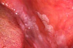 Figure 1: Frictional keratosis Figure 1: Frictional keratosis