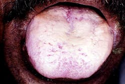 Figure 4: Oral candidiasis Figure 4: Oral candidiasis