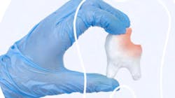 654d53c38d5e13001e7a7c0b Silverdiaminefluoride 654d53c38d5e13001e7a7c0b Silverdiaminefluoride