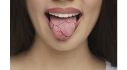 Xerostomia Dry Mouth Image