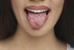Xerostomia Dry Mouth Image