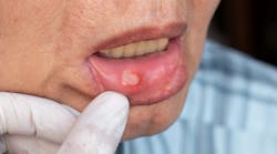 canker-sore-gluten-sensitivity canker-sore-gluten-sensitivity