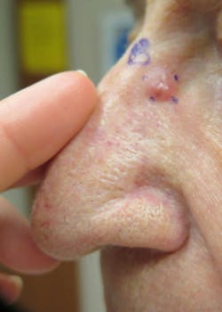 Figure 1: Basal cell carcinoma Figure 1: Basal cell carcinoma
