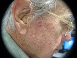 Figure 2: Basal cell carcinoma Figure 2: Basal cell carcinoma