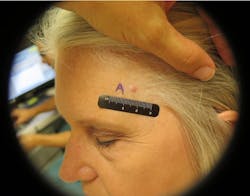 Figure 4: Basal cell carcinoma Figure 4: Basal cell carcinoma