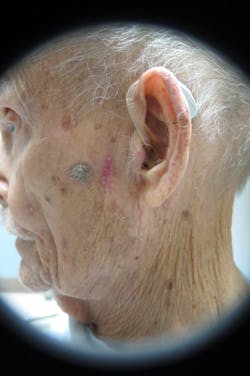 Figure 5: Actinic keratosis Figure 5: Actinic keratosis
