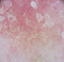 Figure 6: Actinic keratosis Figure 6: Actinic keratosis