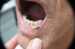 Figure 7: Actinic keratosis Figure 7: Actinic keratosis