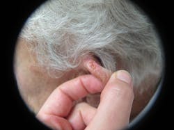 Figure 8: Squamous cell carcinoma Figure 8: Squamous cell carcinoma