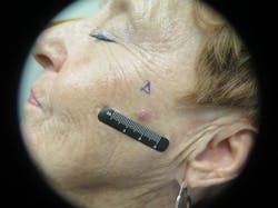 Figure 9: Squamous cell carcinoma Figure 9: Squamous cell carcinoma