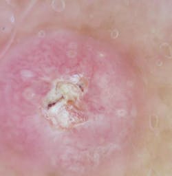 Figure 10: Squamous cell carcinoma Figure 10: Squamous cell carcinoma