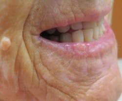 Figure 11: Squamous cell carcinoma Figure 11: Squamous cell carcinoma