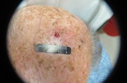 Figure 12: Squamous cell carcinoma Figure 12: Squamous cell carcinoma