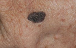 Figure 13: Seborrheic keratosis Figure 13: Seborrheic keratosis