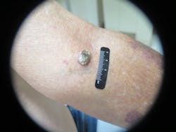 Figure 14: Seborrheic keratosis Figure 14: Seborrheic keratosis