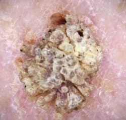 Figure 15: Seborrheic keratosis Figure 15: Seborrheic keratosis