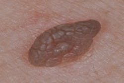 Figure 16: Seborrheic keratosis Figure 16: Seborrheic keratosis