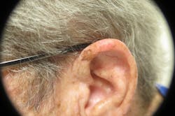 Figure 17: Malignant melanoma Figure 17: Malignant melanoma