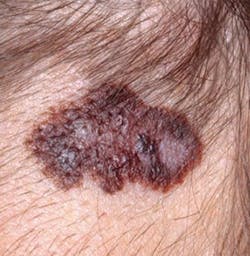 Figure 18: Malignant melanoma