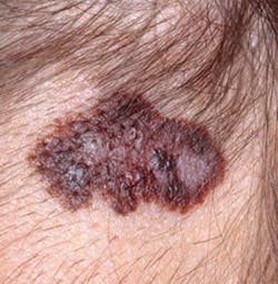Figure 18: Malignant melanoma Figure 18: Malignant melanoma