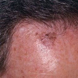 Figure 19: Malignant melanoma Figure 19: Malignant melanoma