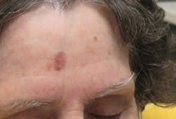 Figure 20: Malignant melanoma Figure 20: Malignant melanoma