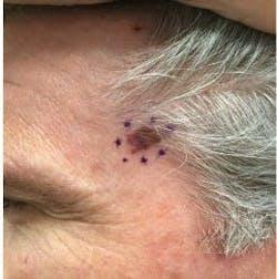 Figure 21: Malignant melanoma Figure 21: Malignant melanoma