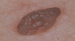 seborrheic-keratosis seborrheic-keratosis