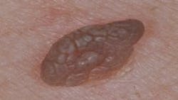 661701fe6c5160001fc36d9f Figure16seborrheic Keratosis 4 661701fe6c5160001fc36d9f Figure16seborrheic Keratosis 4