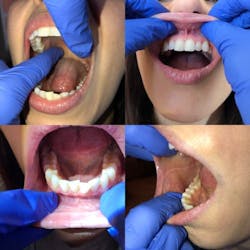 Figure 3: Fully retract the upper and lower lips to examine the vestibule and gingival tissue. Retract the cheek fully to visualize the buccal mucosa. Palpate and visualize the entire hard and soft palate. Figure 3: Fully retract the upper and lower lips to examine the vestibule and gingival tissue. Retract the cheek fully to visualize the buccal mucosa. Palpate and visualize the entire hard and soft palate.