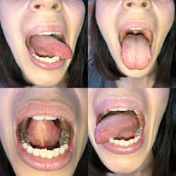 Figure 4: Have the patient stick their tongue out, move it from side to side, and touch it to the roof of their mouth, observing for symmetry in movement and other conditions of the tongue. Figure 4: Have the patient stick their tongue out, move it from side to side, and touch it to the roof of their mouth, observing for symmetry in movement and other conditions of the tongue.