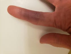 Kirstin's hand with Achenbach syndrome Kirstin's hand with Achenbach syndrome