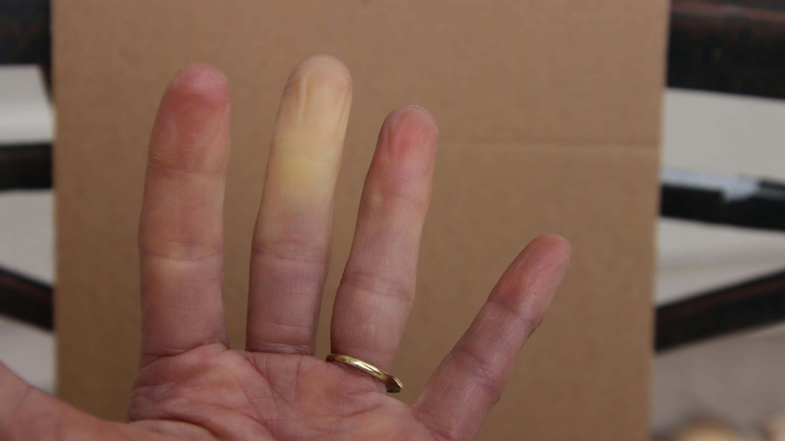 Hand with Raynaud's
