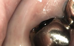 Figure 1: During a hygiene appointment SDF was applied to tooth no. 18 with deep decay 10 days prior to this image. Figure 1: During a hygiene appointment SDF was applied to tooth no. 18 with deep decay 10 days prior to this image.