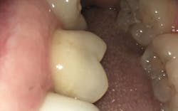 Figure 3: SDF was applied as a desensitizing agent along the gumline with slight recession. Figure 3: SDF was applied as a desensitizing agent along the gumline with slight recession.