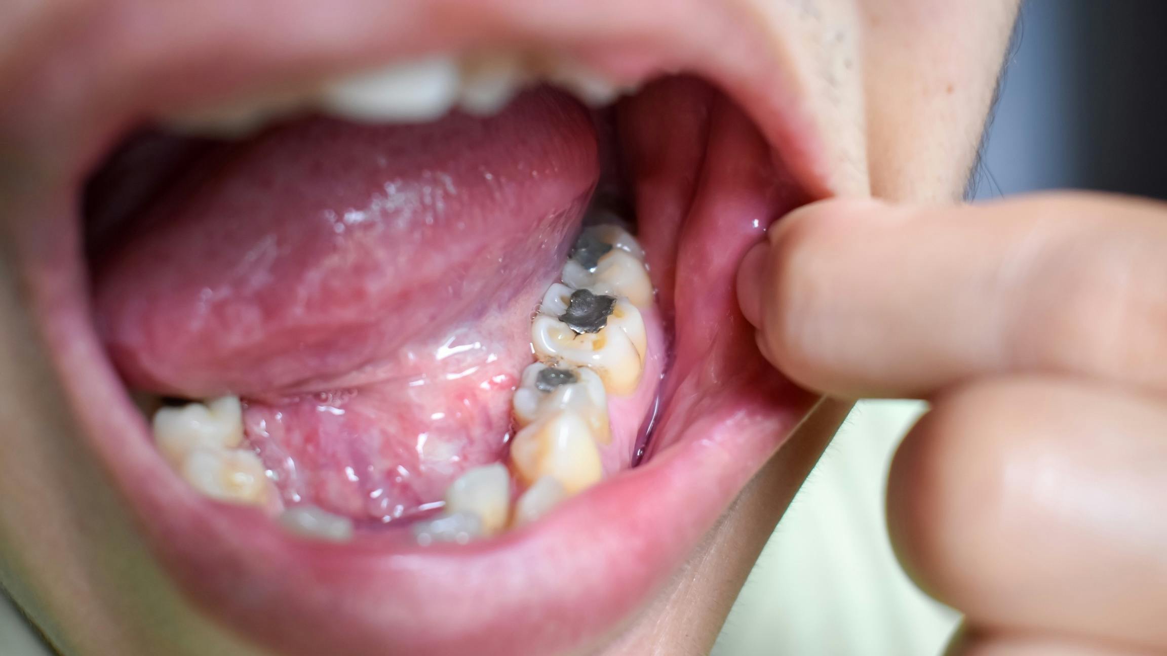 There's mercury in silver fillings.