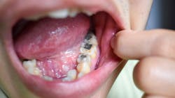 There's mercury in silver fillings. There's mercury in silver fillings.