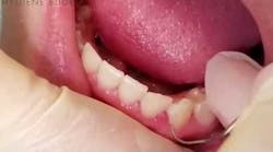 Calculus Detection Tip for the Dental Hygienist Calculus Detection Tip for the Dental Hygienist