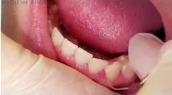 Calculus Detection Tip for the Dental Hygienist Calculus Detection Tip for the Dental Hygienist