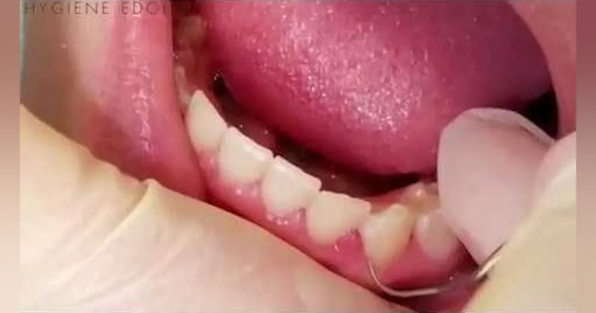 Calculus Detecting Solution Calculus detection tip for dental hygienists | Registered Dental Hygienists