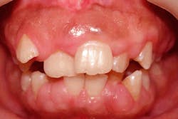 Hereditary gingival fibromatosis Hereditary gingival fibromatosis